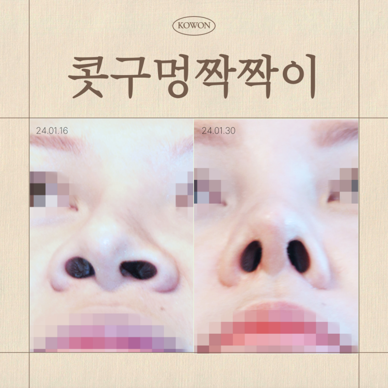 콧구멍짝짝이, 콧구멍 비대칭 언제 점검해야 할까