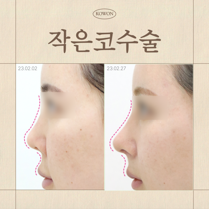 작은코수술, 강남 코성형외과 선택 기준은