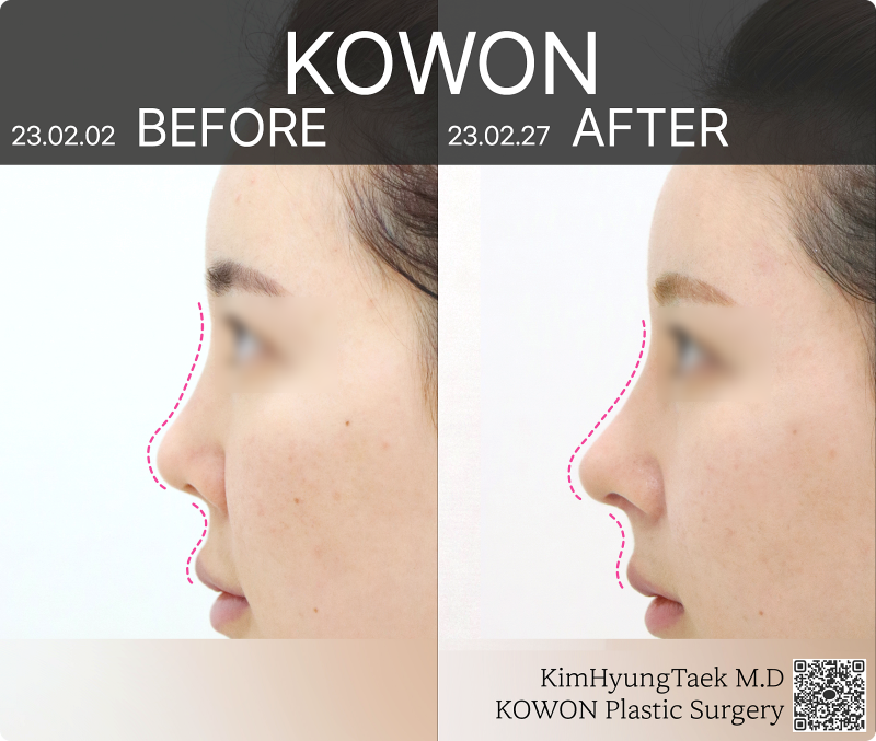 작은코수술, 강남 코성형외과 선택 기준은 사진 7