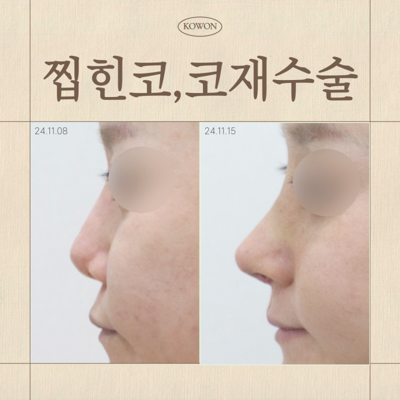 찝힌코, 코재수술이 필요한 상태일까요?