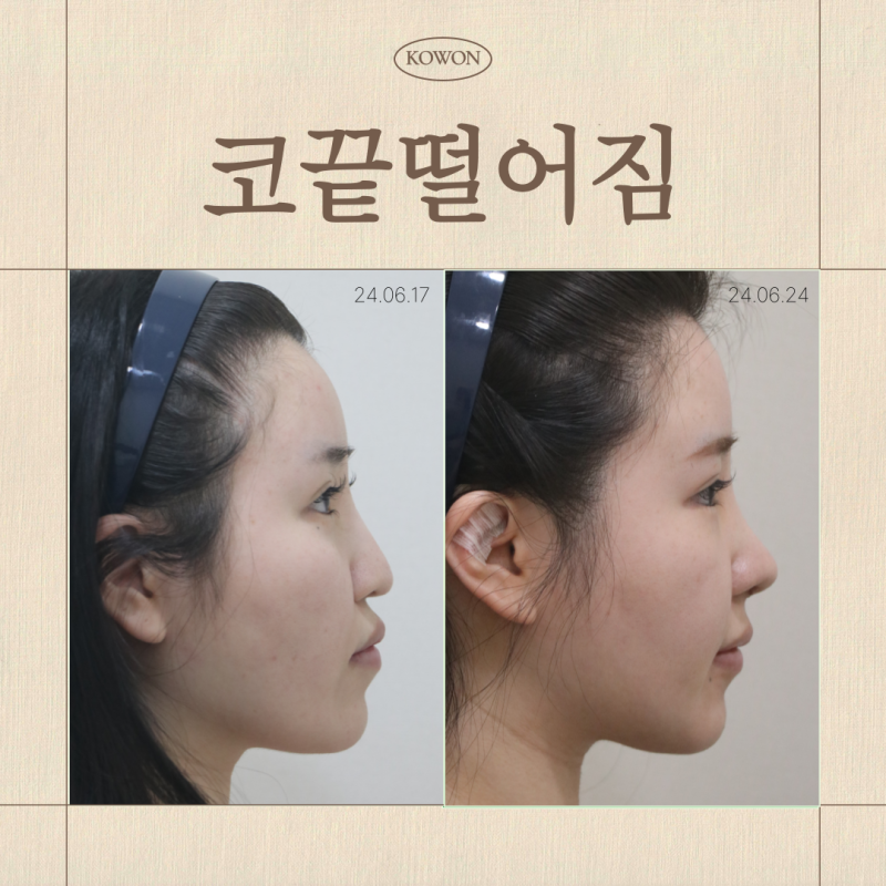 코끝떨어짐, 코끝성형 후 처지는 느낌은 정상일까요?