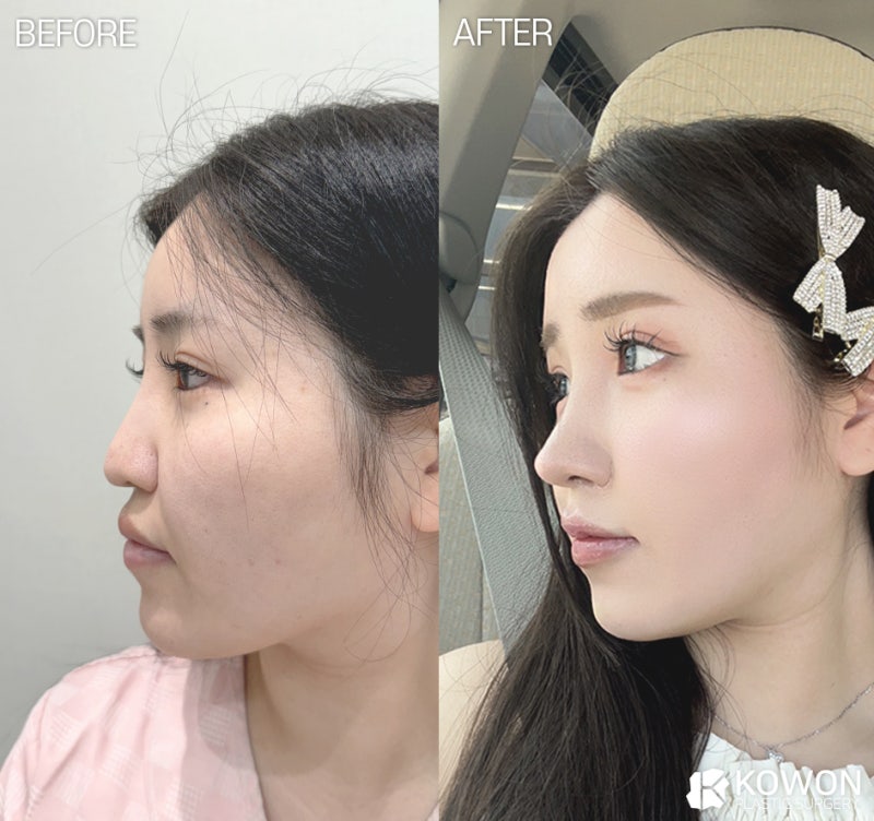 코끝떨어짐, 코끝성형 후 처지는 느낌은 정상일까요? 사진 8