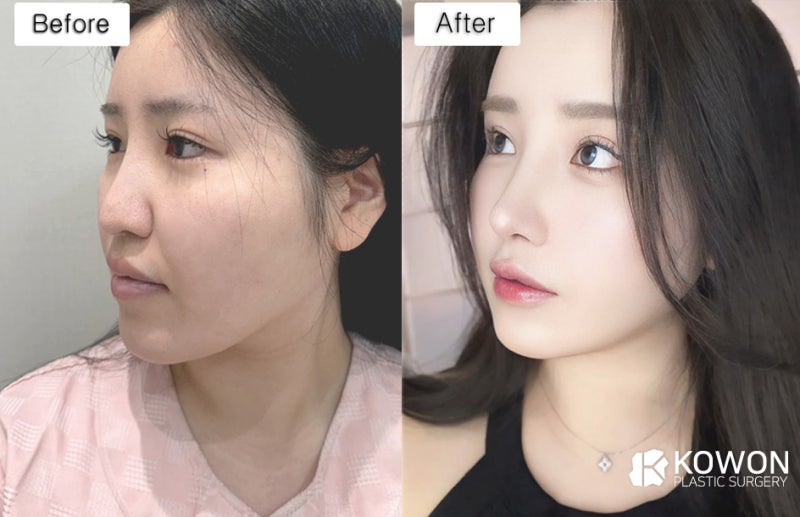 코끝떨어짐, 코끝성형 후 처지는 느낌은 정상일까요? 사진 7
