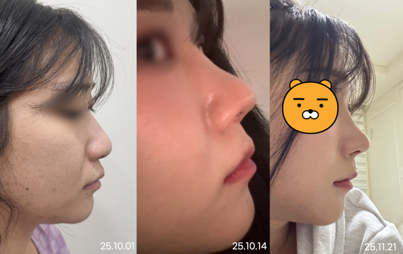 비순각수술, 돌출입이 아닌데 입이 나와 보이는 이유는? 사진 8