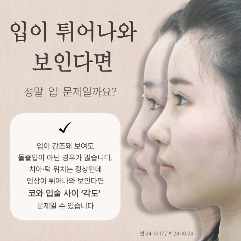 비순각수술, 돌출입이 아닌데 입이 나와 보이는 이유는? 사진 3