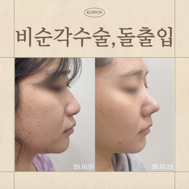 비순각수술, 돌출입이 아닌데 입이 나와 보이는 이유는?