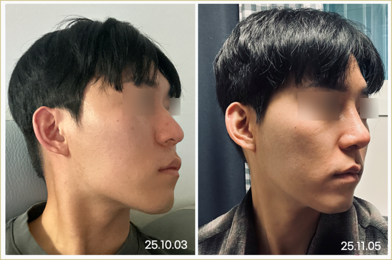 남자복코, 신사역 코성형외과 선택 기준은 무엇일까요? 사진 9