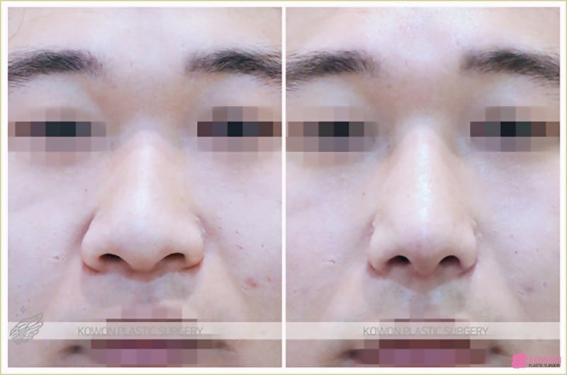 남자복코, 신사역 코성형외과 선택 기준은 무엇일까요? 사진 8