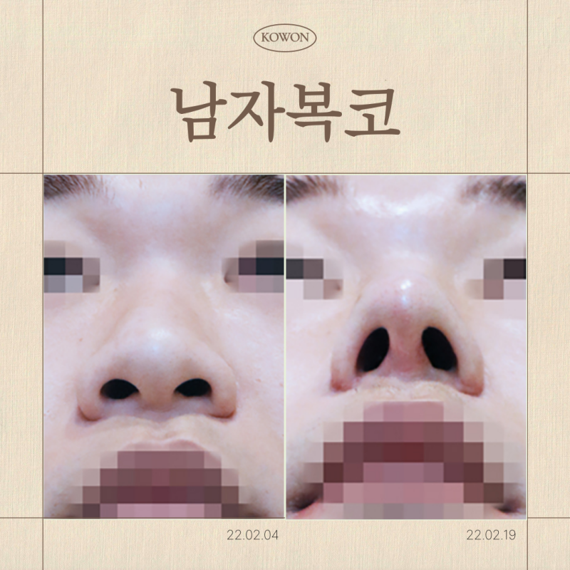 남자복코, 신사역 코성형외과 선택 기준은 무엇일까요?