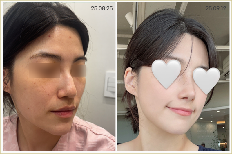 여자매부리코, 무보형물코수술로도 교정이 가능할까요? 사진 8