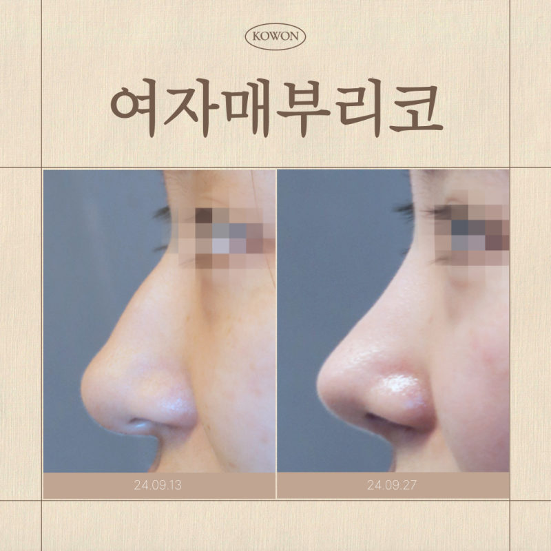 여자매부리코, 무보형물코수술로도 교정이 가능할까요?