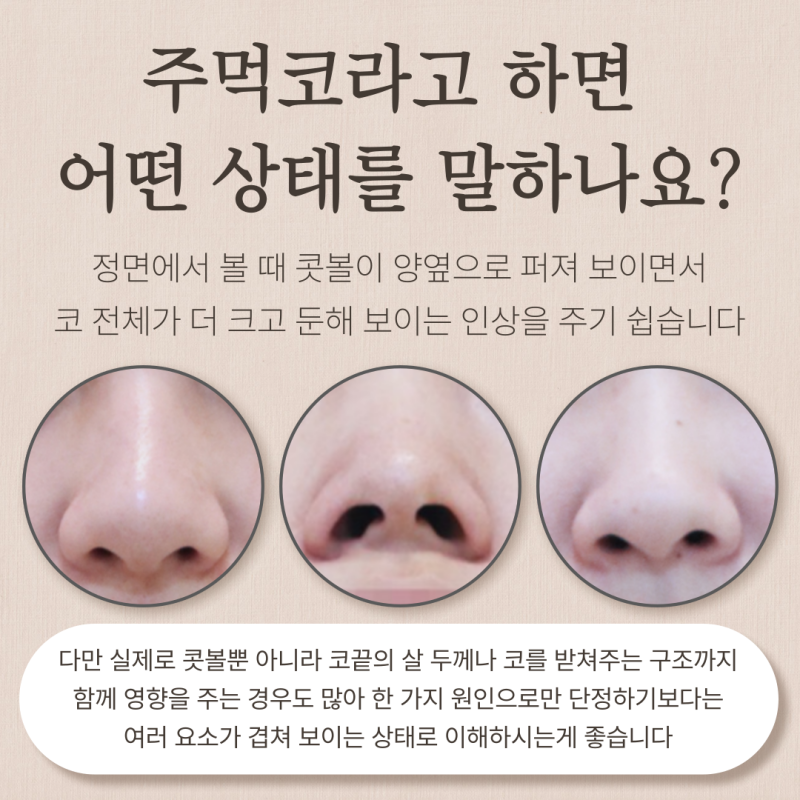 콧볼축소병원, 주먹코인데 콧볼축소만 하면 될까요? 사진 3