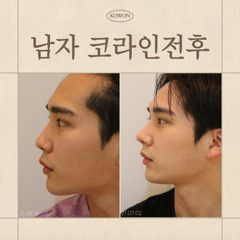 남자코수술전후, 코라인은 어떻게 골라야 할까요?