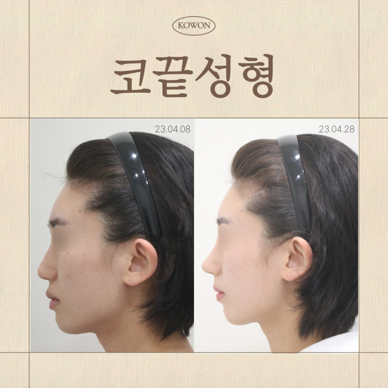 뭉툭한코, 코끝성형은 왜 ‘끝’만 보면 안 될까요?