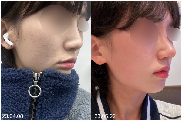 뭉툭한코, 코끝성형은 왜 ‘끝’만 보면 안 될까요? 사진 9