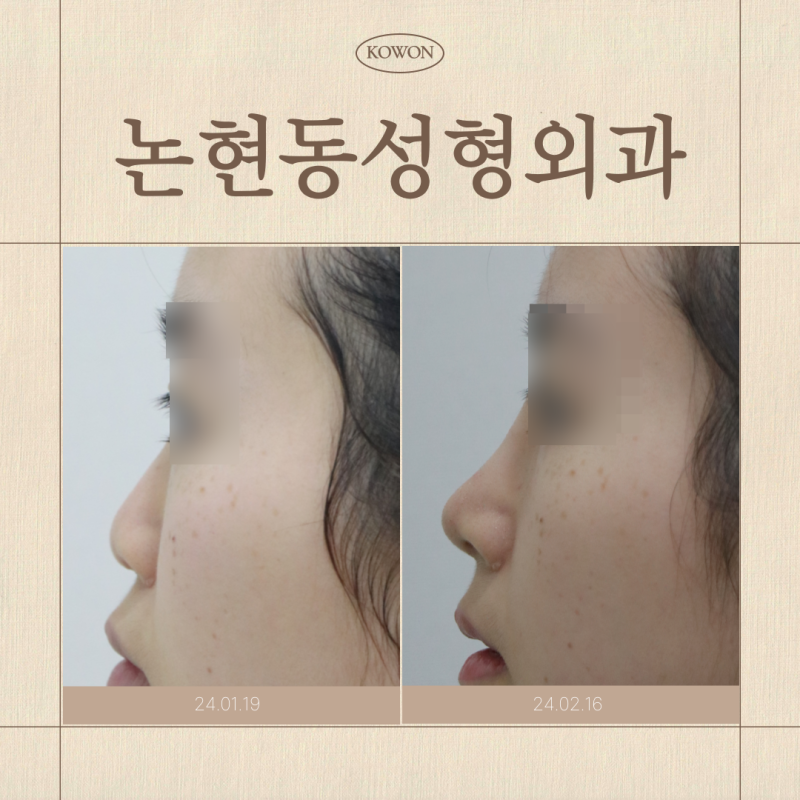 논현동성형외과, 코수술 어디까지 보고 결정해야 할까요? 재료 선택 기준까지