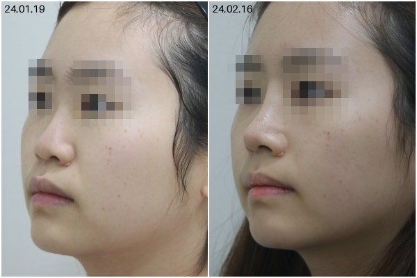 논현동성형외과, 코수술 어디까지 보고 결정해야 할까요? 재료 선택 기준까지 사진 3