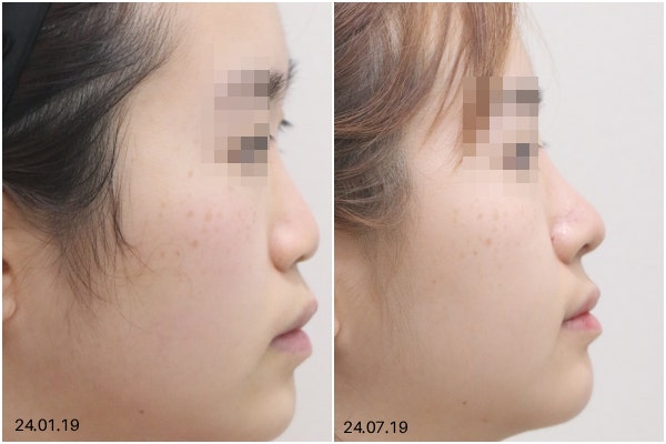 논현동성형외과, 코수술 어디까지 보고 결정해야 할까요? 재료 선택 기준까지 사진 7