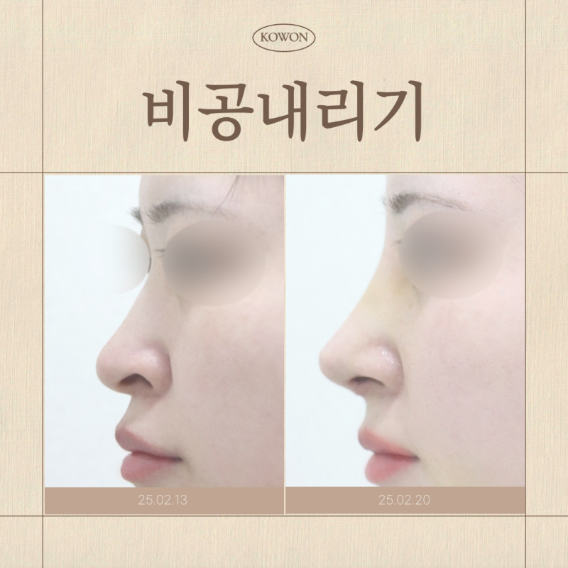 비공내리기, 용코는 왜 생기고 어떻게 판단해야 할까요?