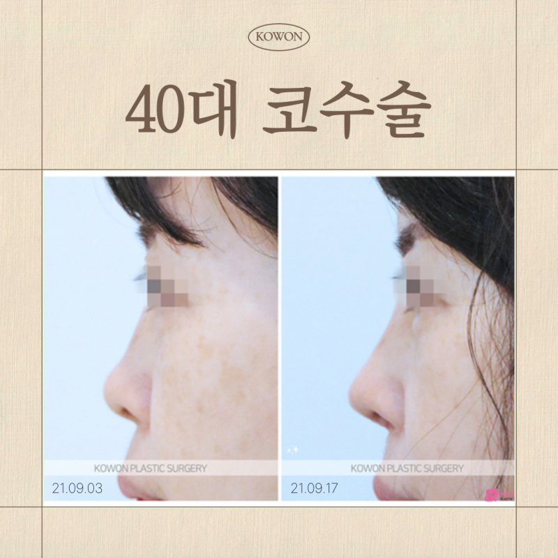 40대코수술 회복 괜찮을까요? 자가늑연골·자가조직보형물까지 고민된다면