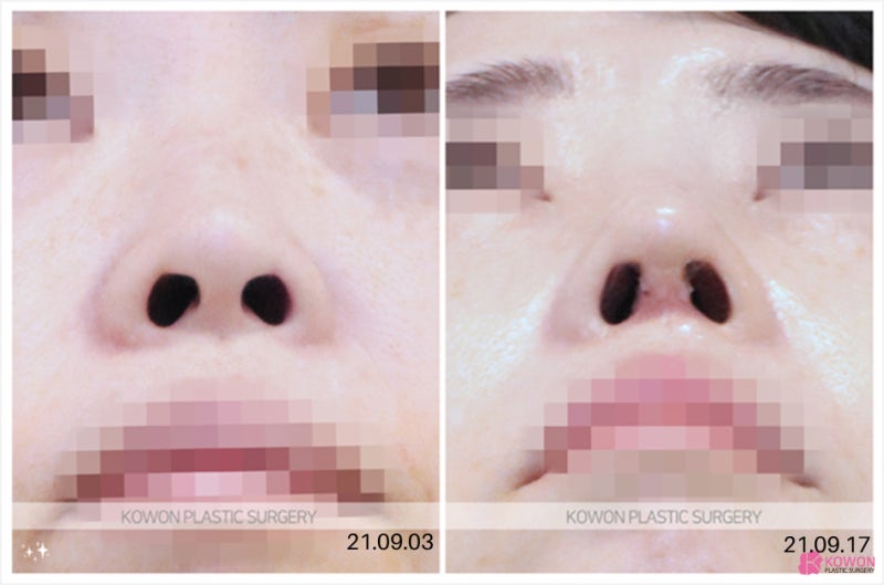 40대코수술 회복 괜찮을까요? 자가늑연골·자가조직보형물까지 고민된다면 사진 5