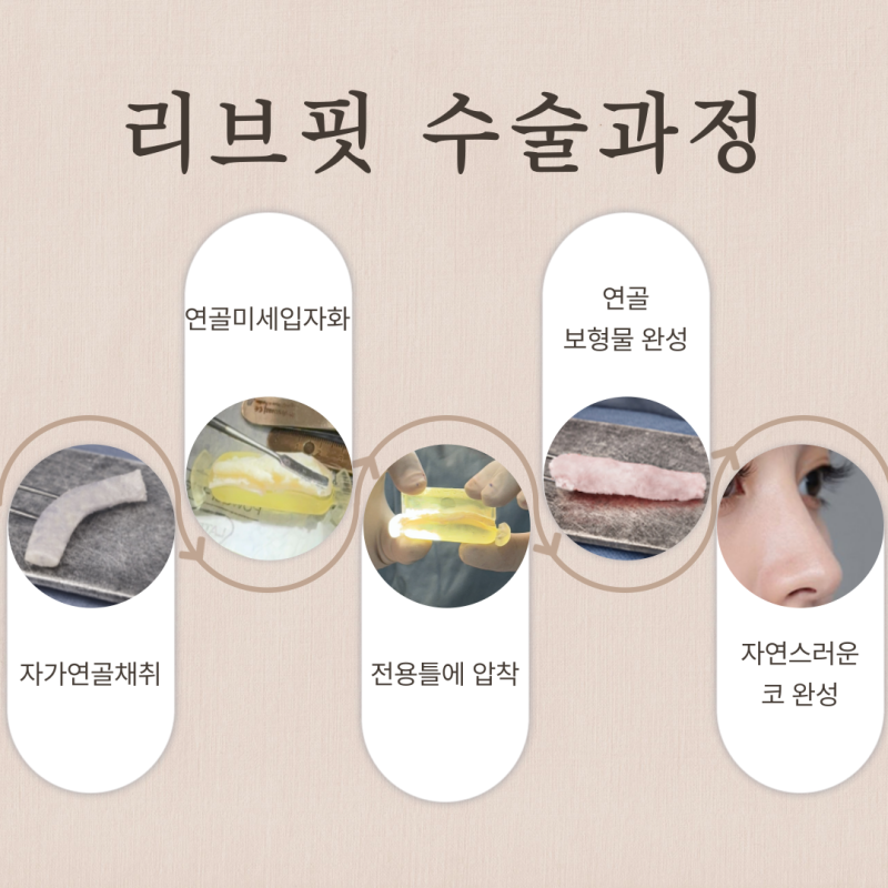 40대코수술 회복 괜찮을까요? 자가늑연골·자가조직보형물까지 고민된다면 사진 7