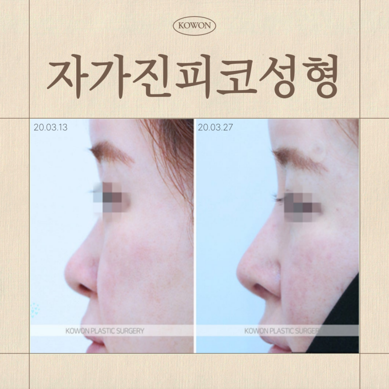 자가진피코성형, 자가조직코수술이라던데… 다 같은 건가요?
