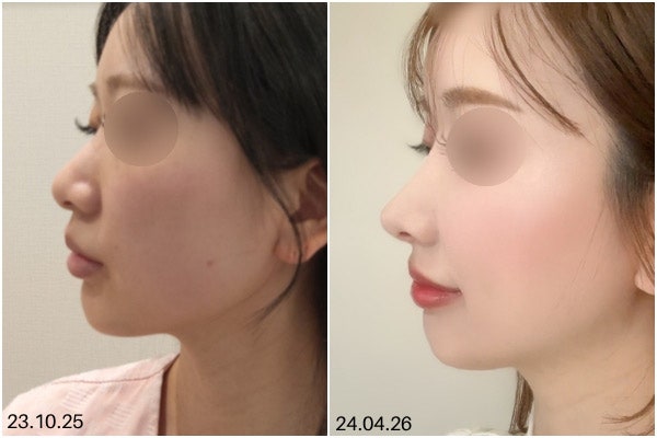 코끝높이기, 무조건 올리면 될까요?비순각을 먼저 봐야 하는 이유 사진 7
