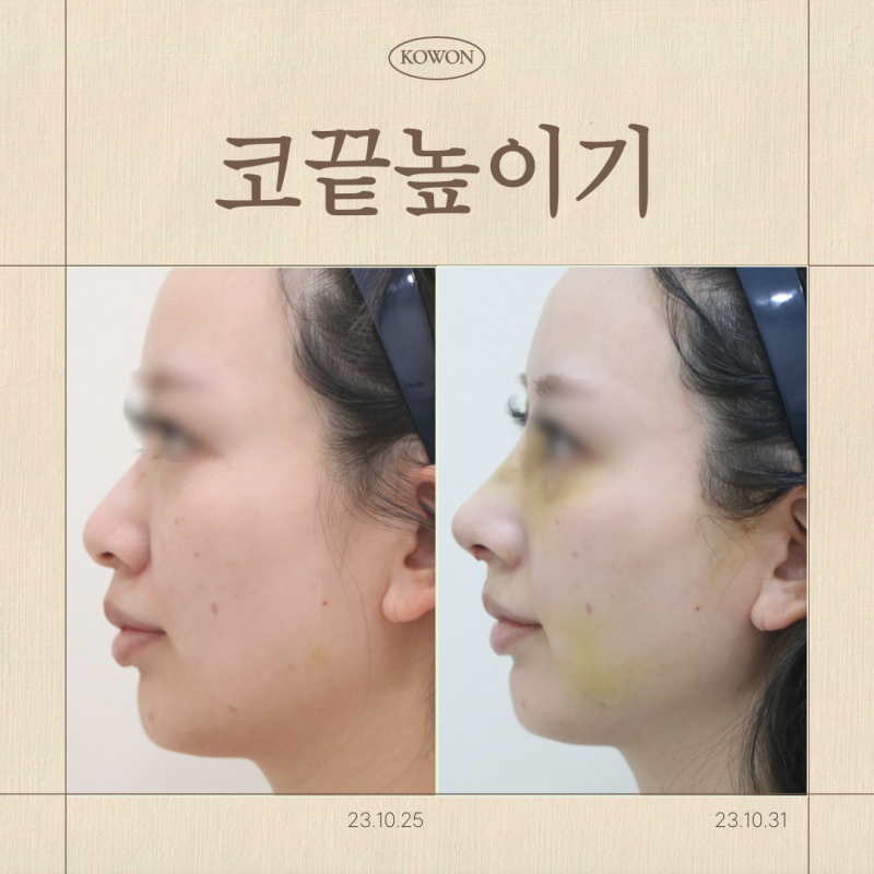 코끝높이기, 무조건 올리면 될까요?비순각을 먼저 봐야 하는 이유