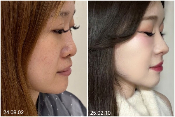 코실리콘제거 후 코재수술, 자가조직 무엇이 맞을까 사진 8