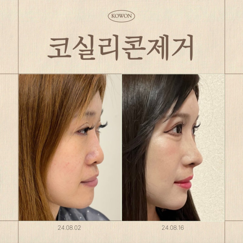 코실리콘제거 후 코재수술, 자가조직 무엇이 맞을까