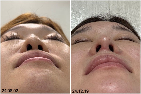 코실리콘제거 후 코재수술, 자가조직 무엇이 맞을까 사진 6