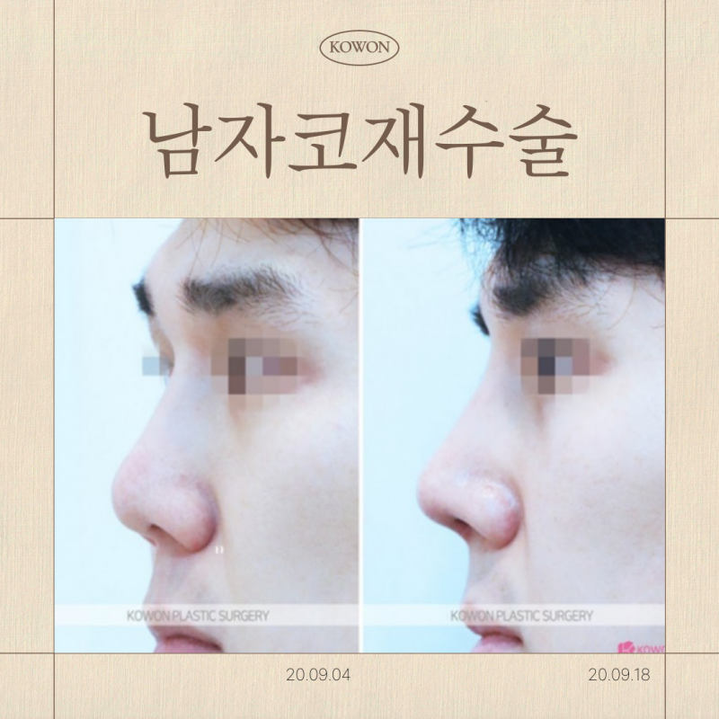 남자코재수술 리브핏, 왜 찾을까요?