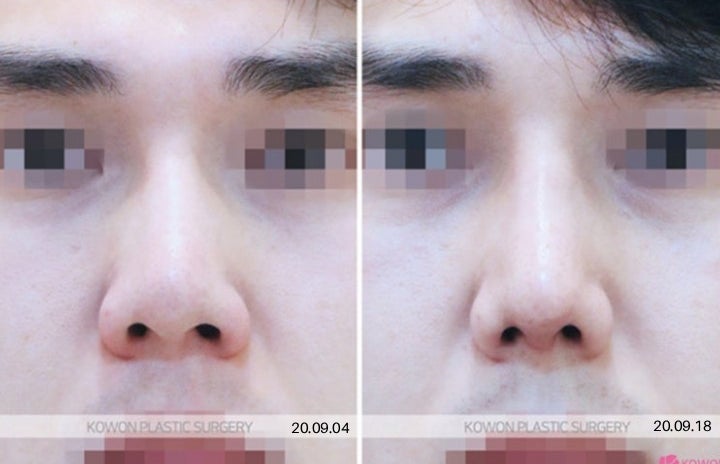 남자코재수술 리브핏, 왜 찾을까요? 사진 3