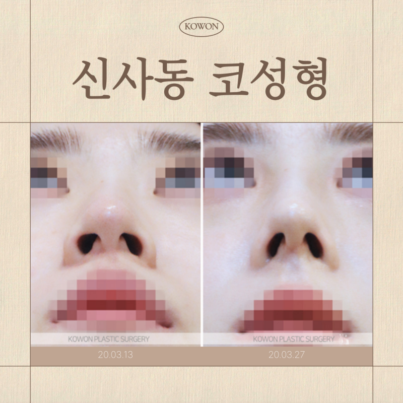 신사동코성형, 무보형물코수술 가능한 코는?