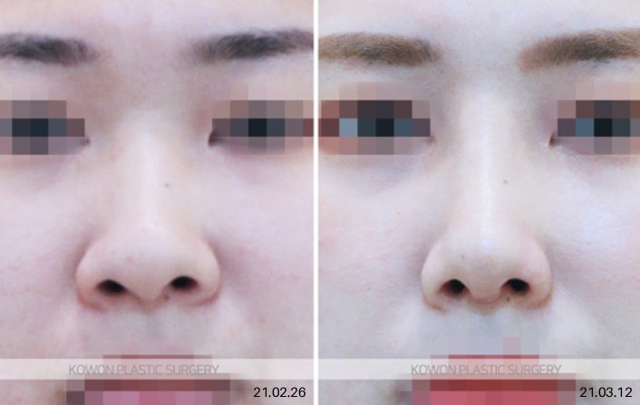 코끝연골묶기, 복코도 묶기만으로 충분할까요? 사진 9