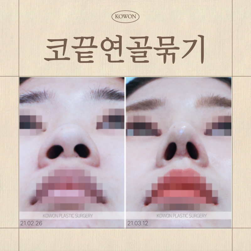 코끝연골묶기, 복코도 묶기만으로 충분할까요?
