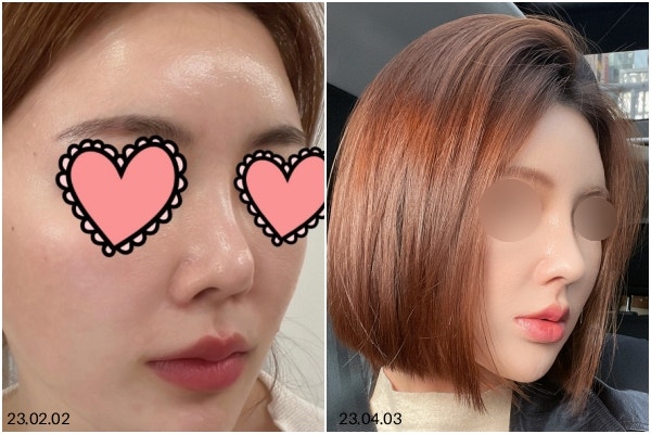 코끝통증, 염증일까요? 코재수술까지 가는 경우는 언제인가요? 사진 7