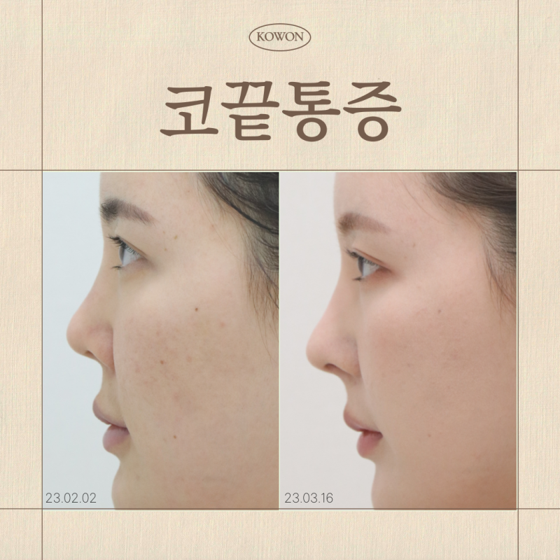 코끝통증, 염증일까요? 코재수술까지 가는 경우는 언제인가요?