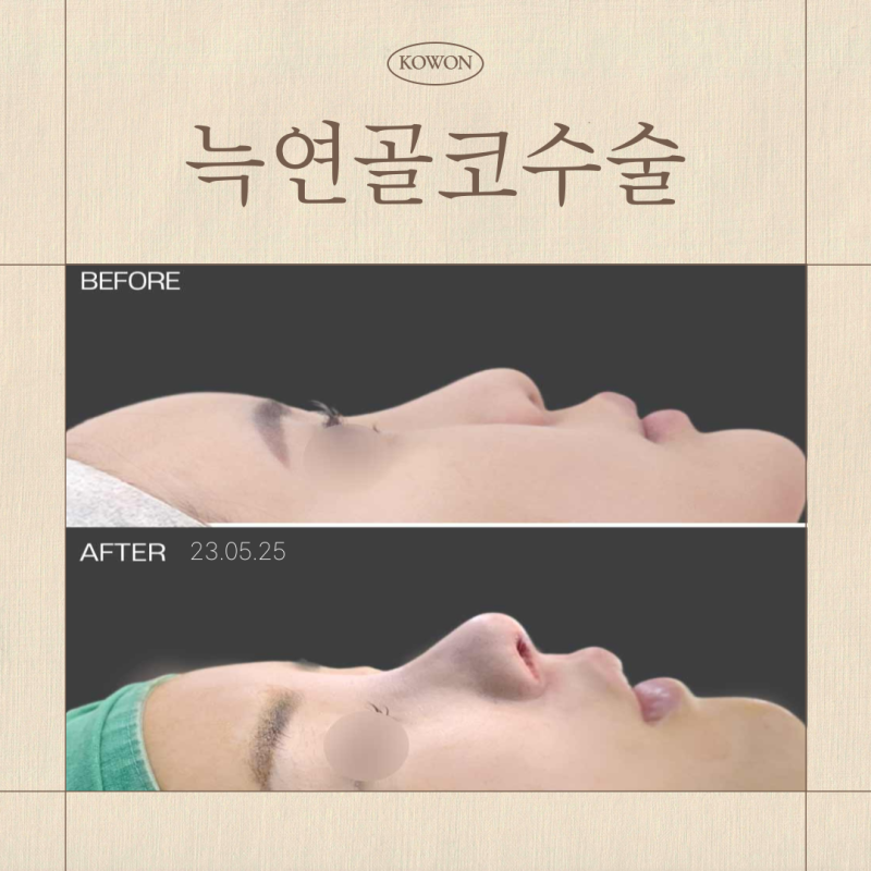 늑연골코수술, 무보형물코수술 가능할까요?
