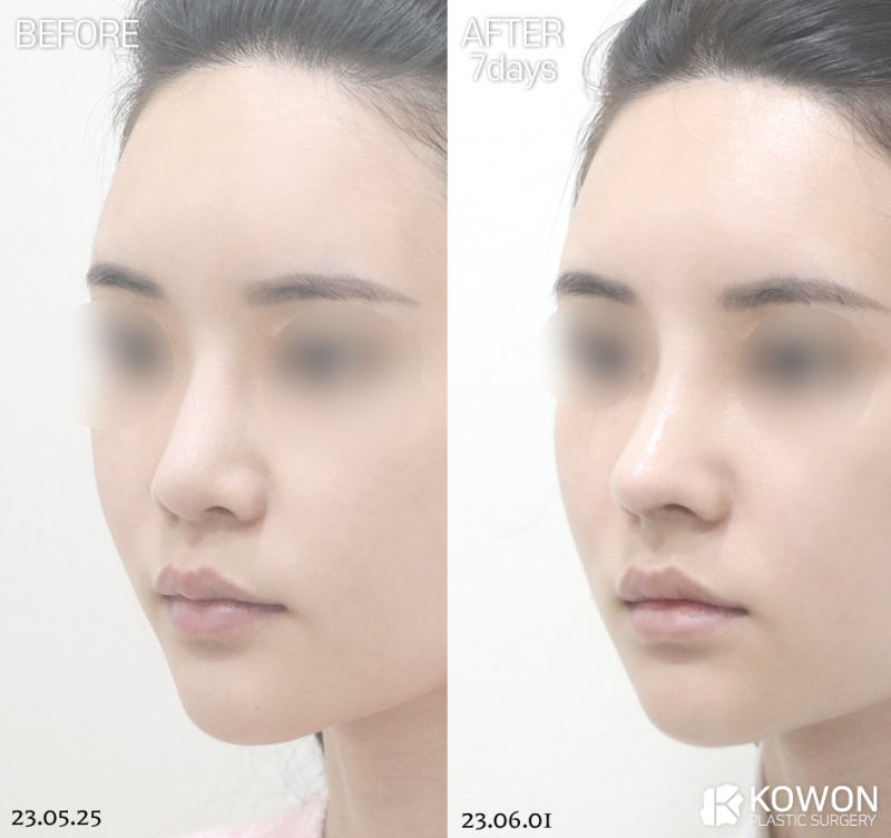 늑연골코수술, 무보형물코수술 가능할까요? 사진 9