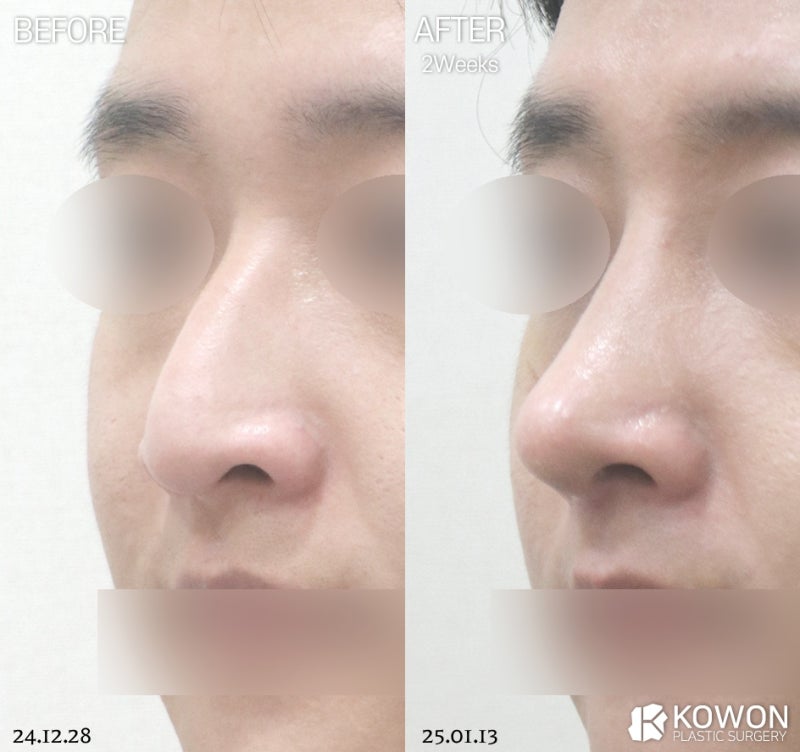 남자코수술후기, 직선코 나도 어울릴까? 사진 4