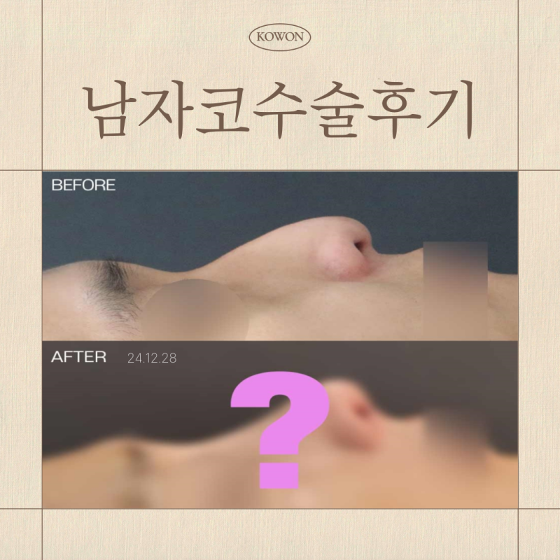 남자코수술후기, 직선코 나도 어울릴까?