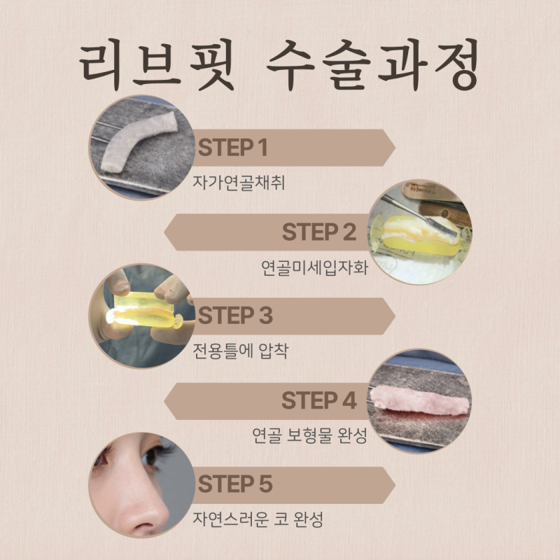 남자코수술후기, 직선코 나도 어울릴까? 사진 7