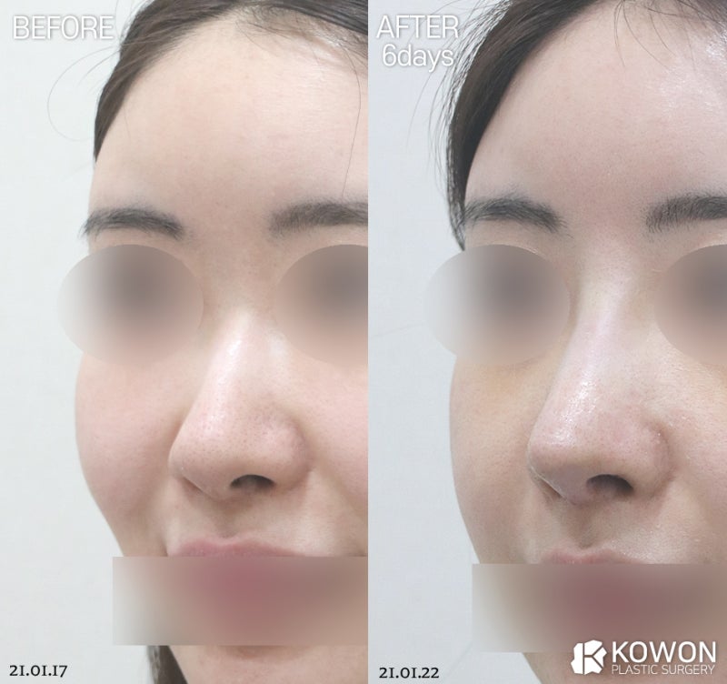 코성형잘하는병원 기준, 코재수술 시 무보형물코수술이 답일까? 사진 7