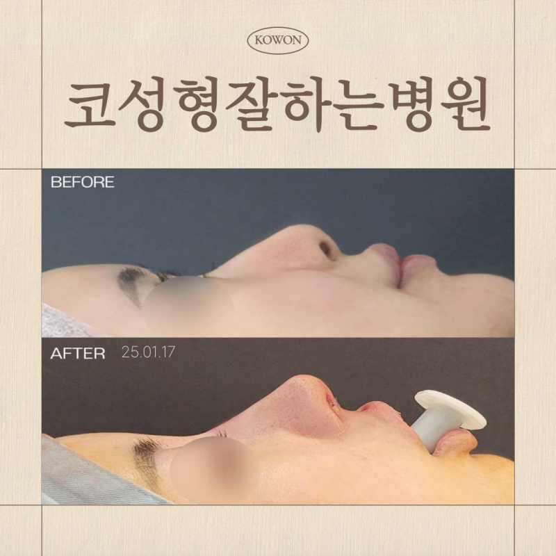 코성형잘하는병원 기준, 코재수술 시 무보형물코수술이 답일까?