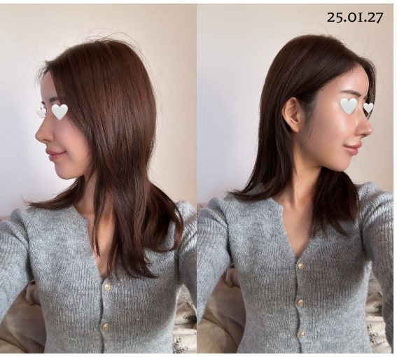 코성형잘하는병원 기준, 코재수술 시 무보형물코수술이 답일까? 사진 8