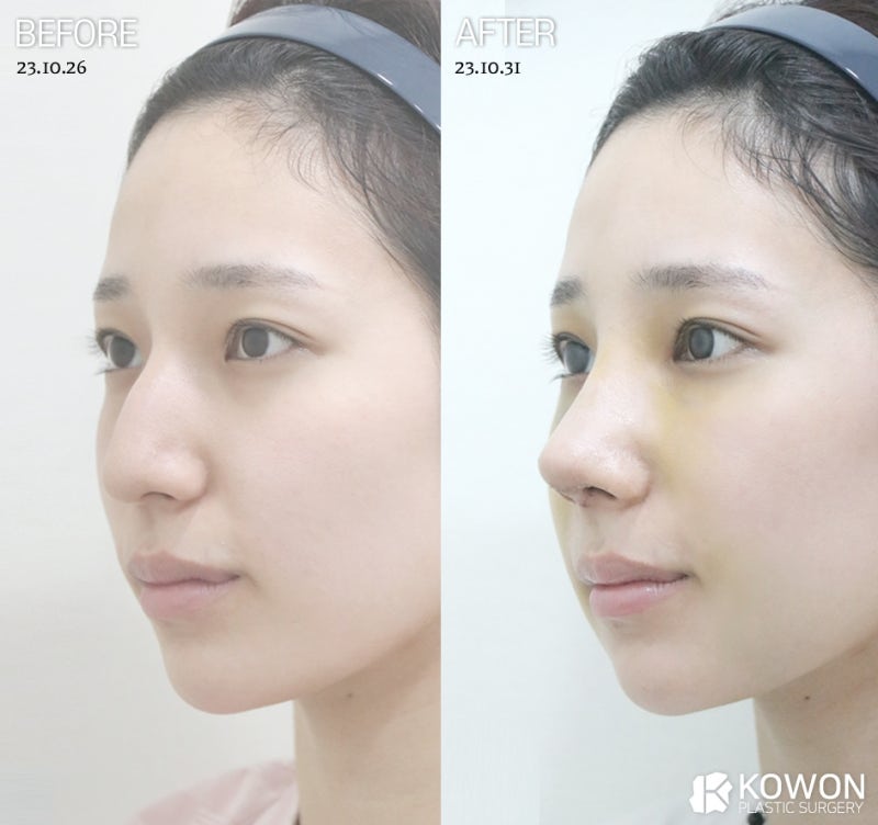 코절골술, 매부리코 정말 뼈를 깎는 과정이 필수일까요? 사진 5