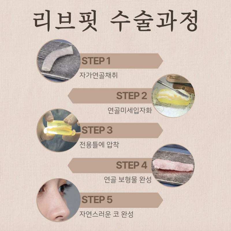 코절골술, 매부리코 정말 뼈를 깎는 과정이 필수일까요? 사진 6