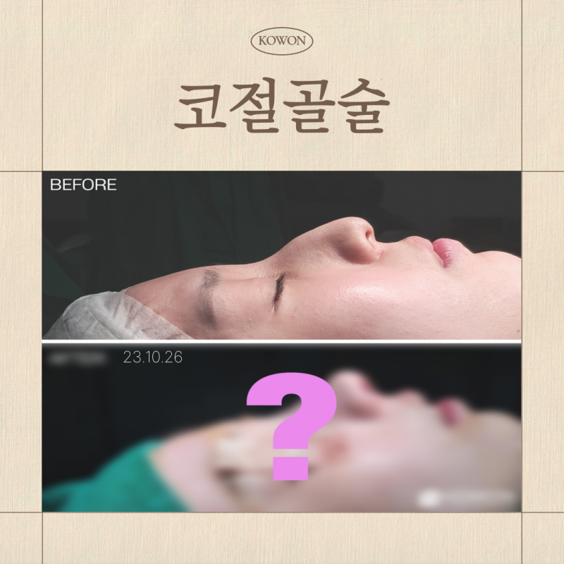 코절골술, 매부리코 정말 뼈를 깎는 과정이 필수일까요?